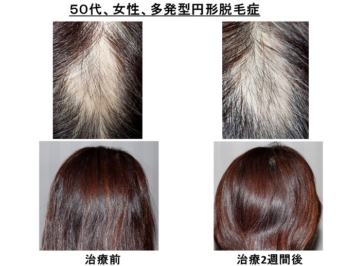 汎発性脱毛　病院